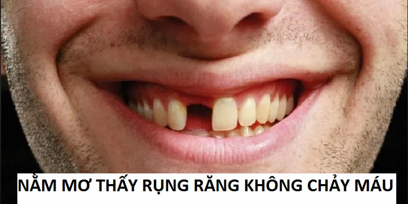 nằm mơ thấy rụng răng không chảy máu